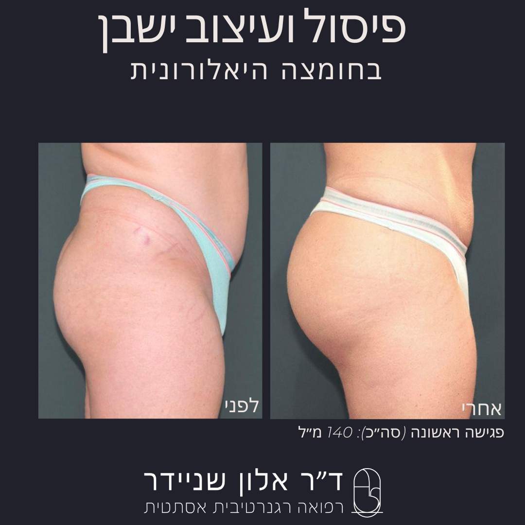 طب التجميل | الدكتور ألون شنايدر عيادة نورديكا