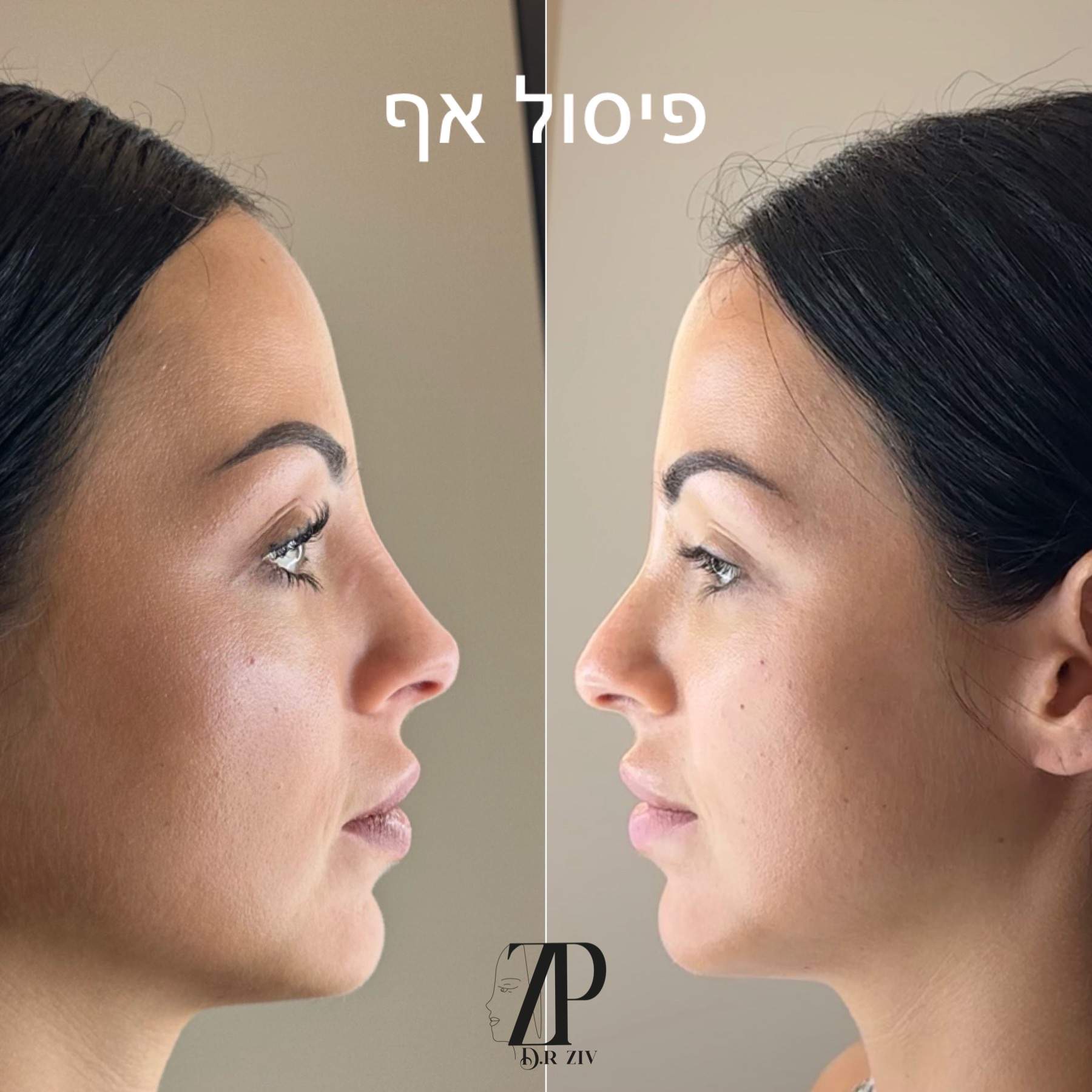 Nose Sculpting | Dr. Ziv Peretz