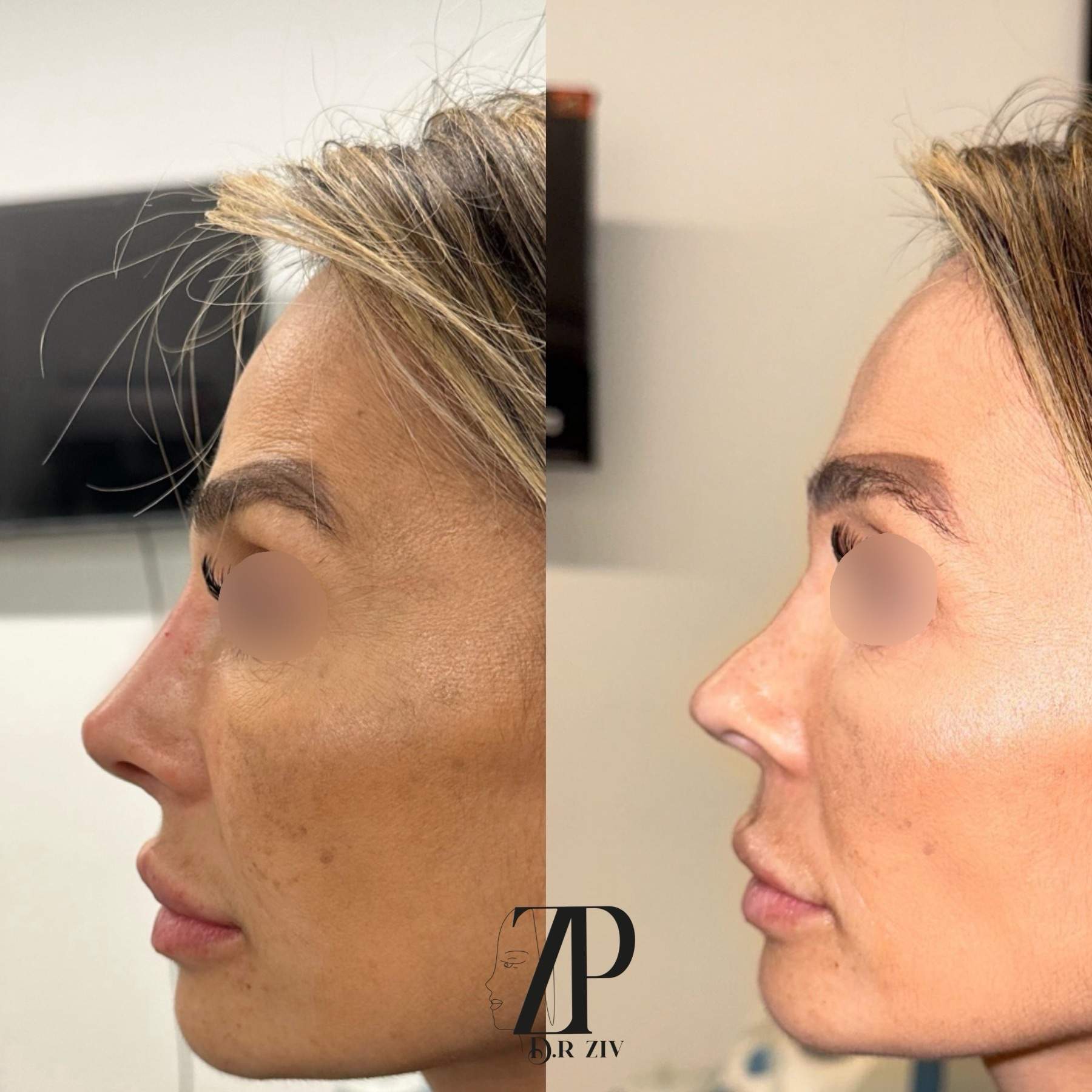 Nose Sculpting | Dr. Ziv Peretz