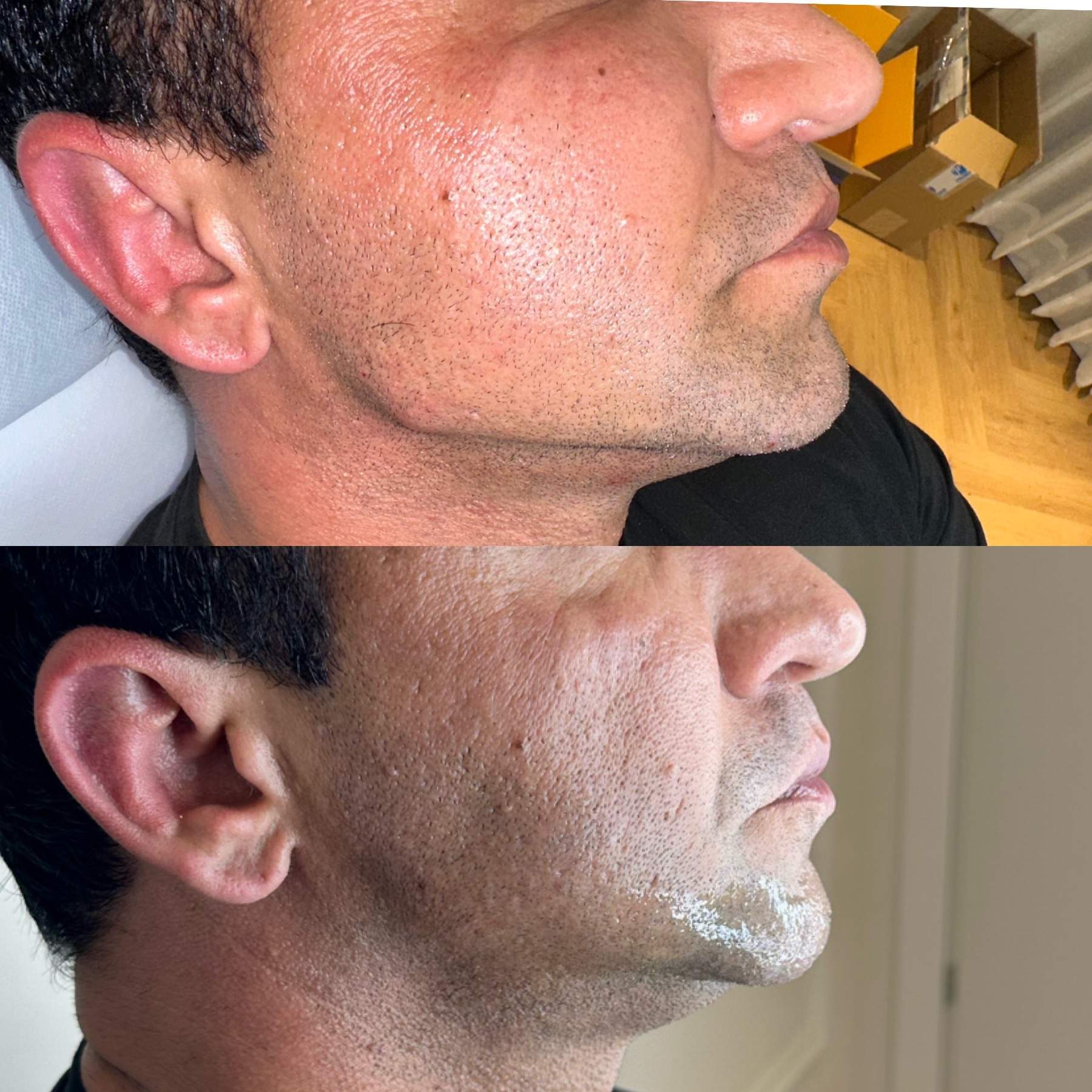Jawline Tightening | Dr. Ziv Peretz