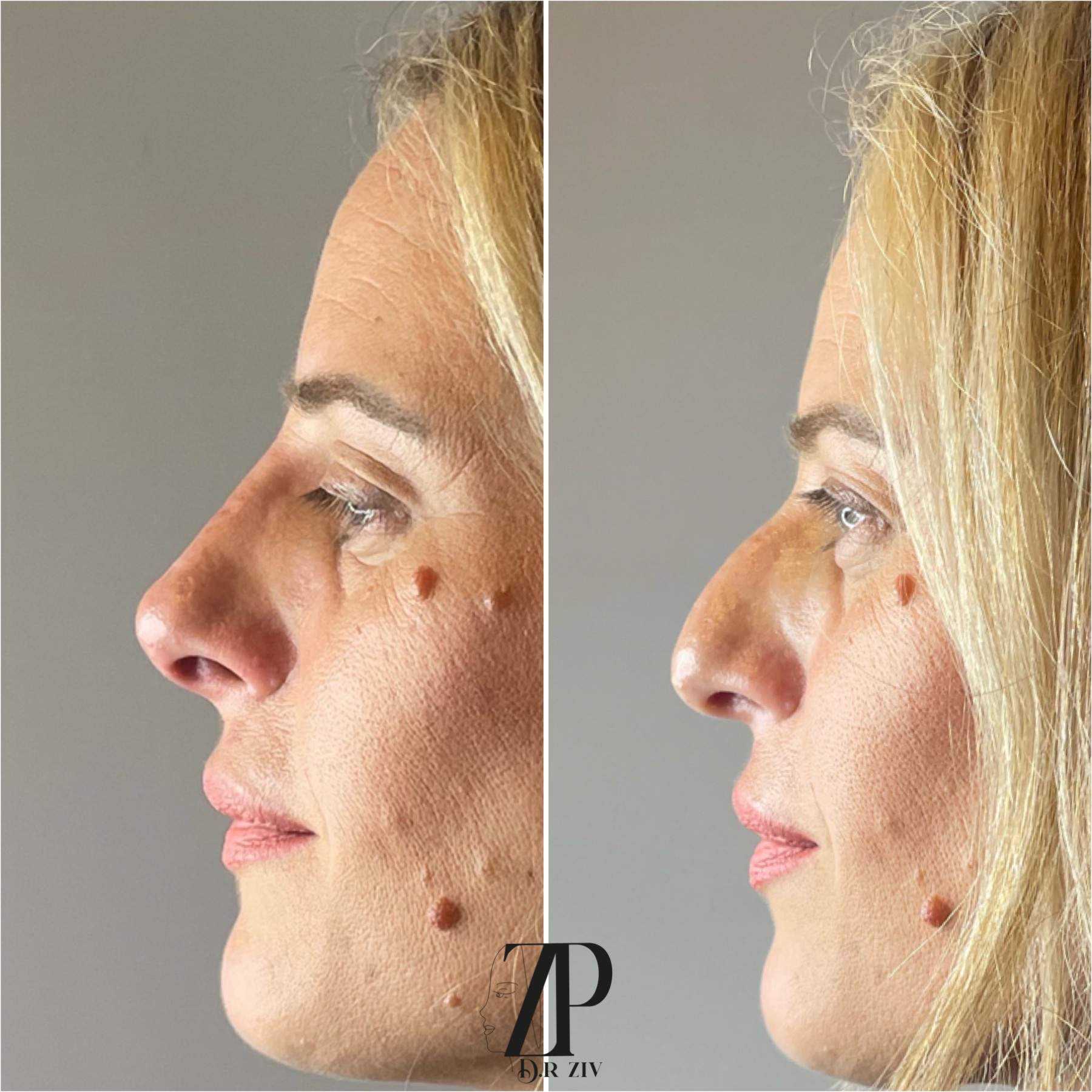 Nose Sculpting | Dr. Ziv Peretz
