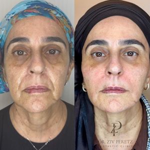 Aesthetic Medicine | Dr. Ziv Peretz