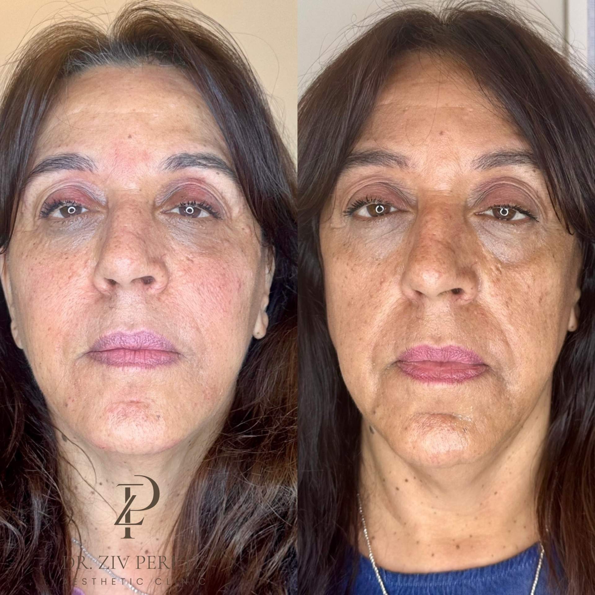 Cheeks Enhancement | Dr. Ziv Peretz