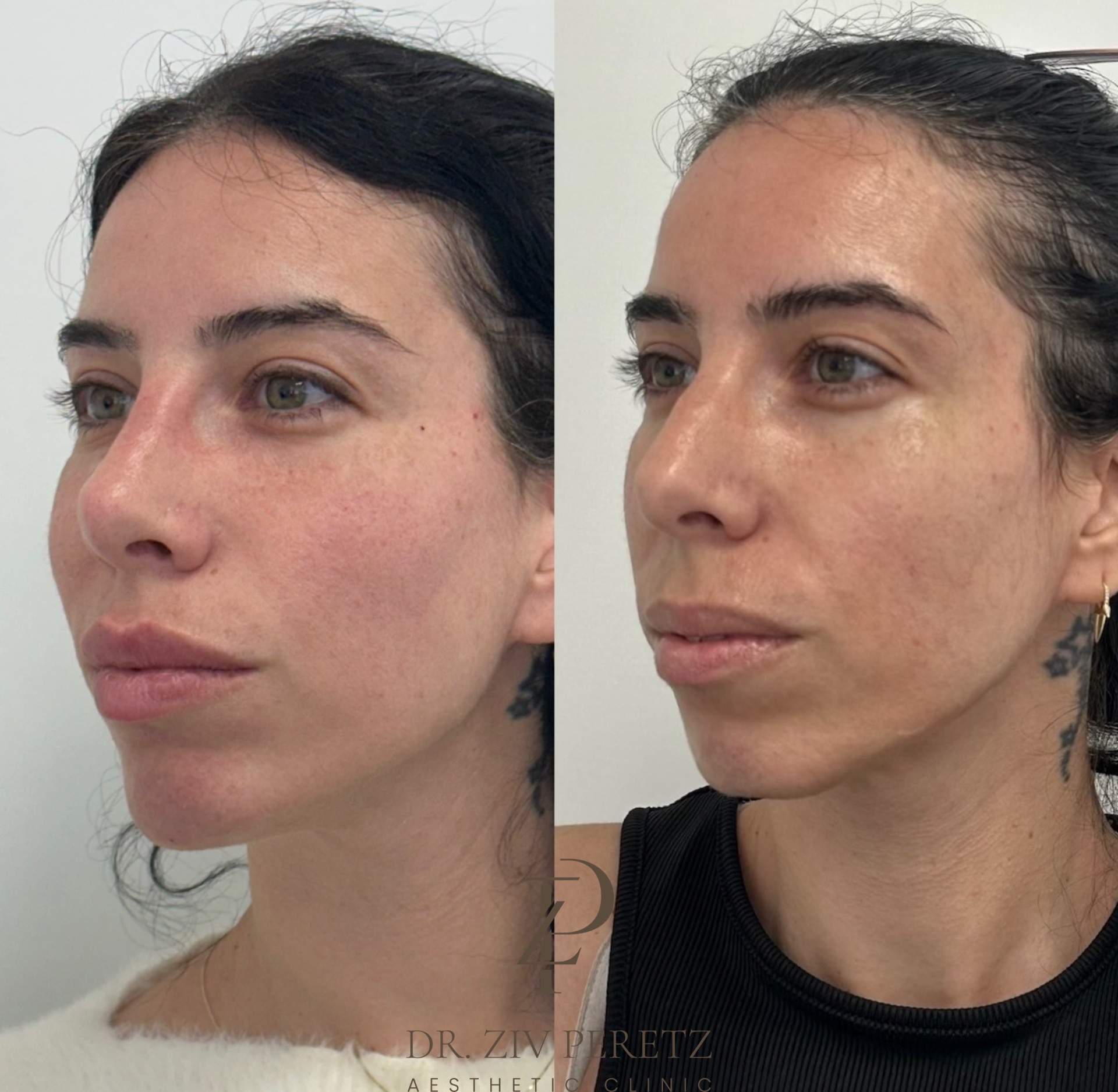 Face Sculpter | Dr. Ziv Peretz