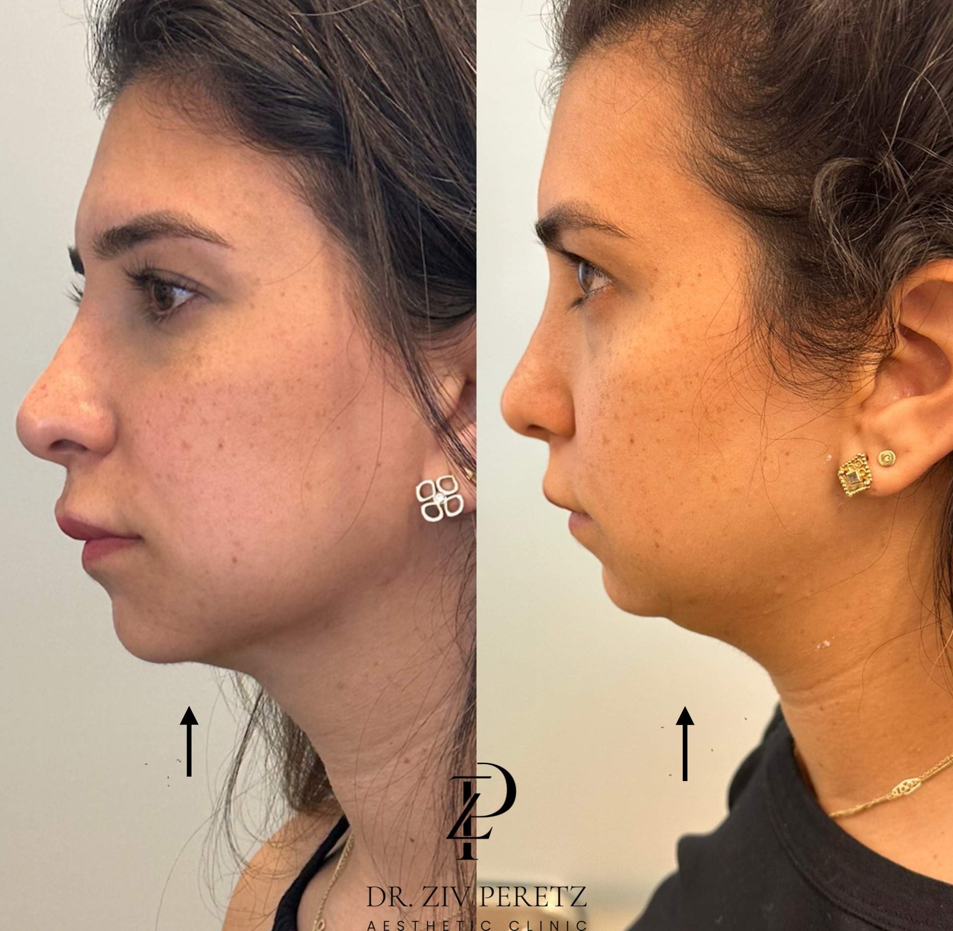 Neck Lipolysis | Dr. Ziv Peretz