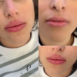 Aesthetic Medicine | Dr. Ziv Peretz