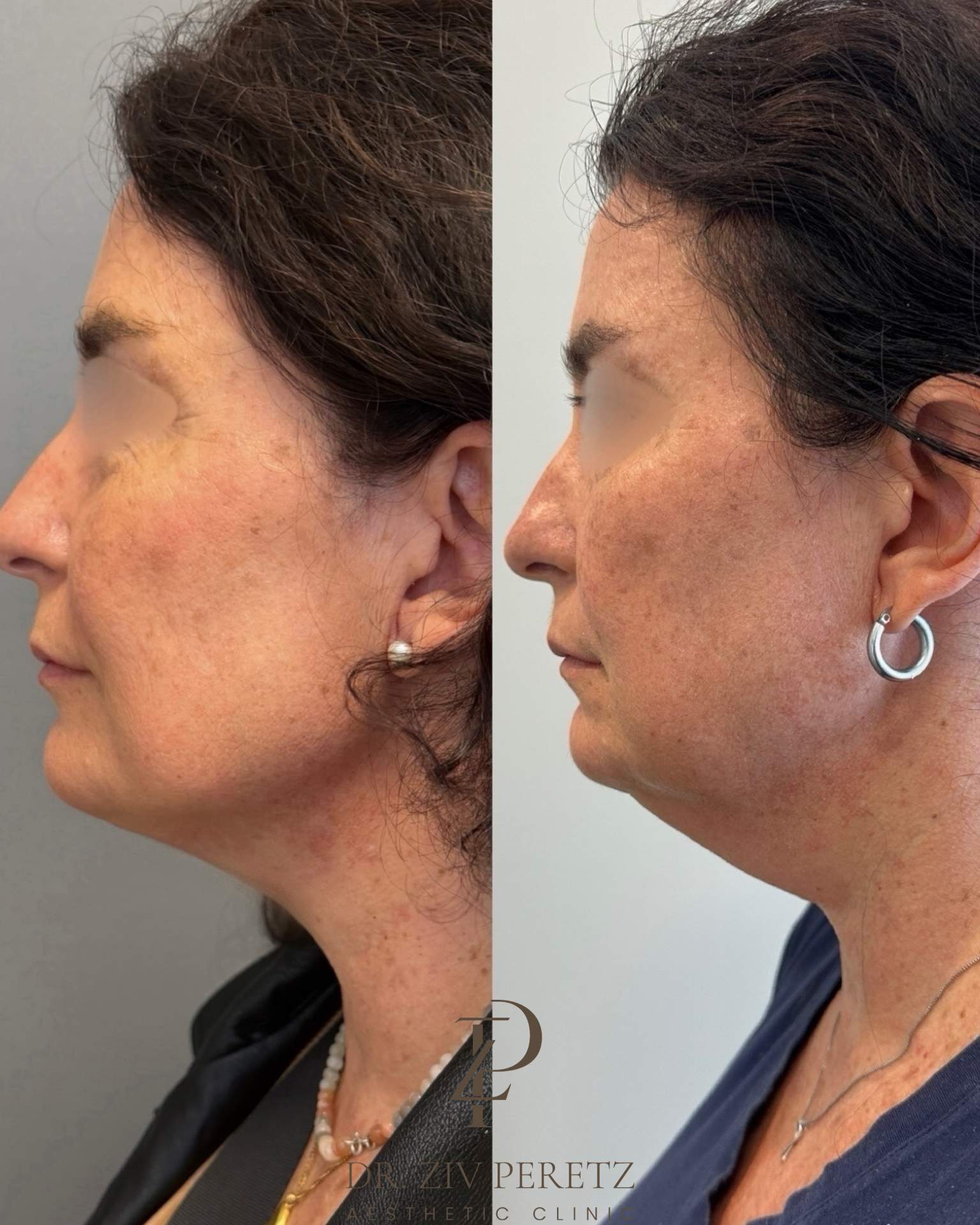 Neck Lipolysis | Dr. Ziv Peretz