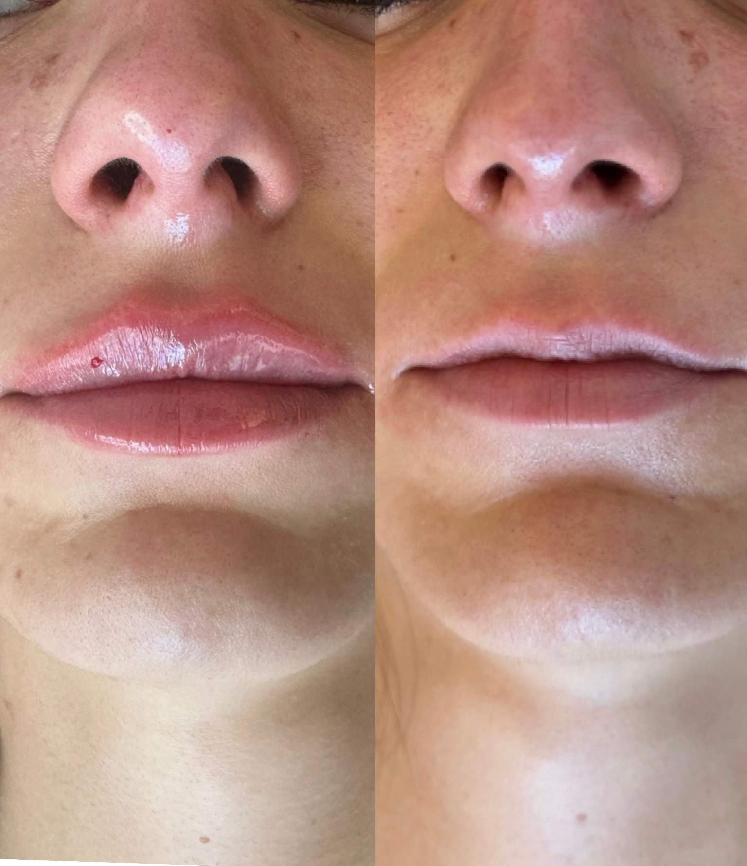 Liposculpter | Dr. Ziv Peretz