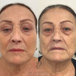 Aesthetic Medicine | Dr. Ziv Peretz