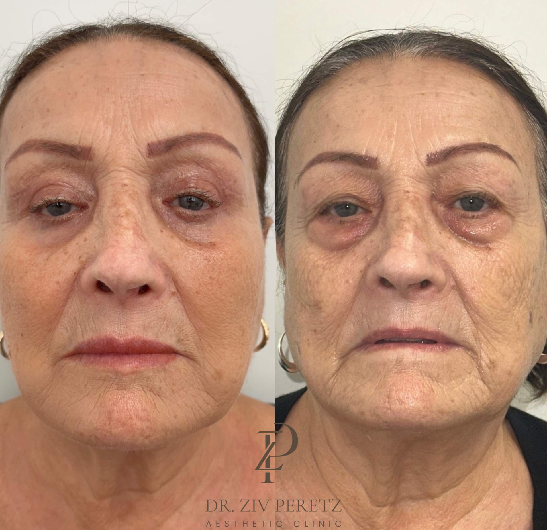Aesthetic Medicine | Dr. Ziv Peretz