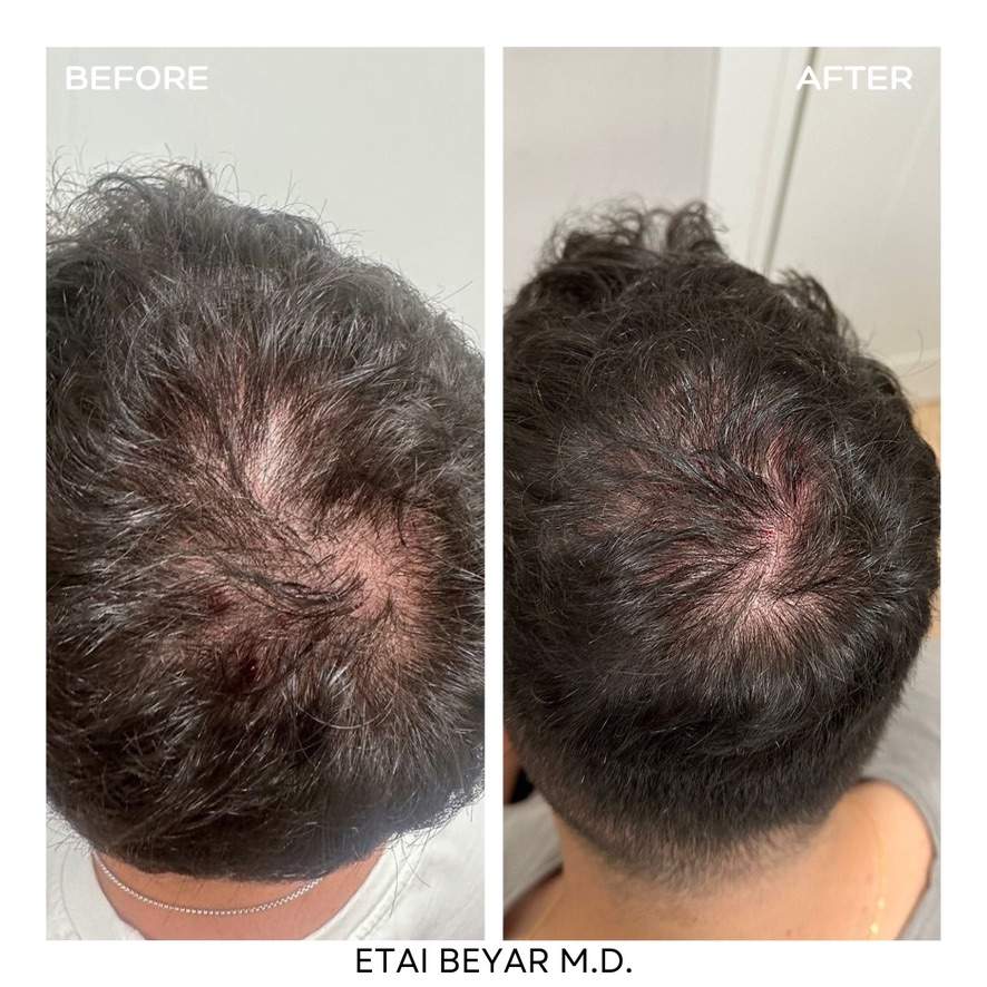 Prp For Hair | Dr. Etai Beyar