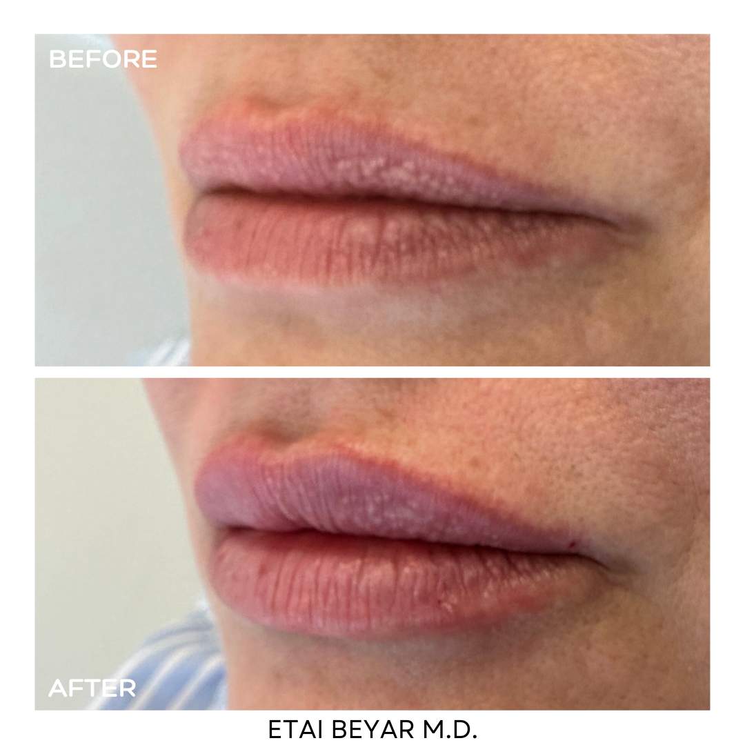 Liposculpter | Dr. Etai Beyar