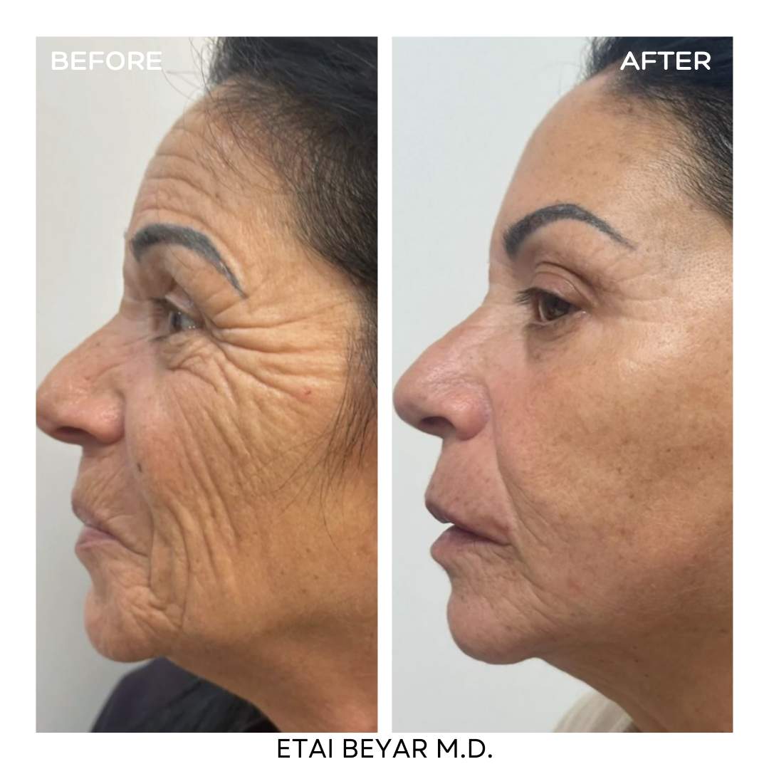 Botox Injection | Dr. Etai Beyar