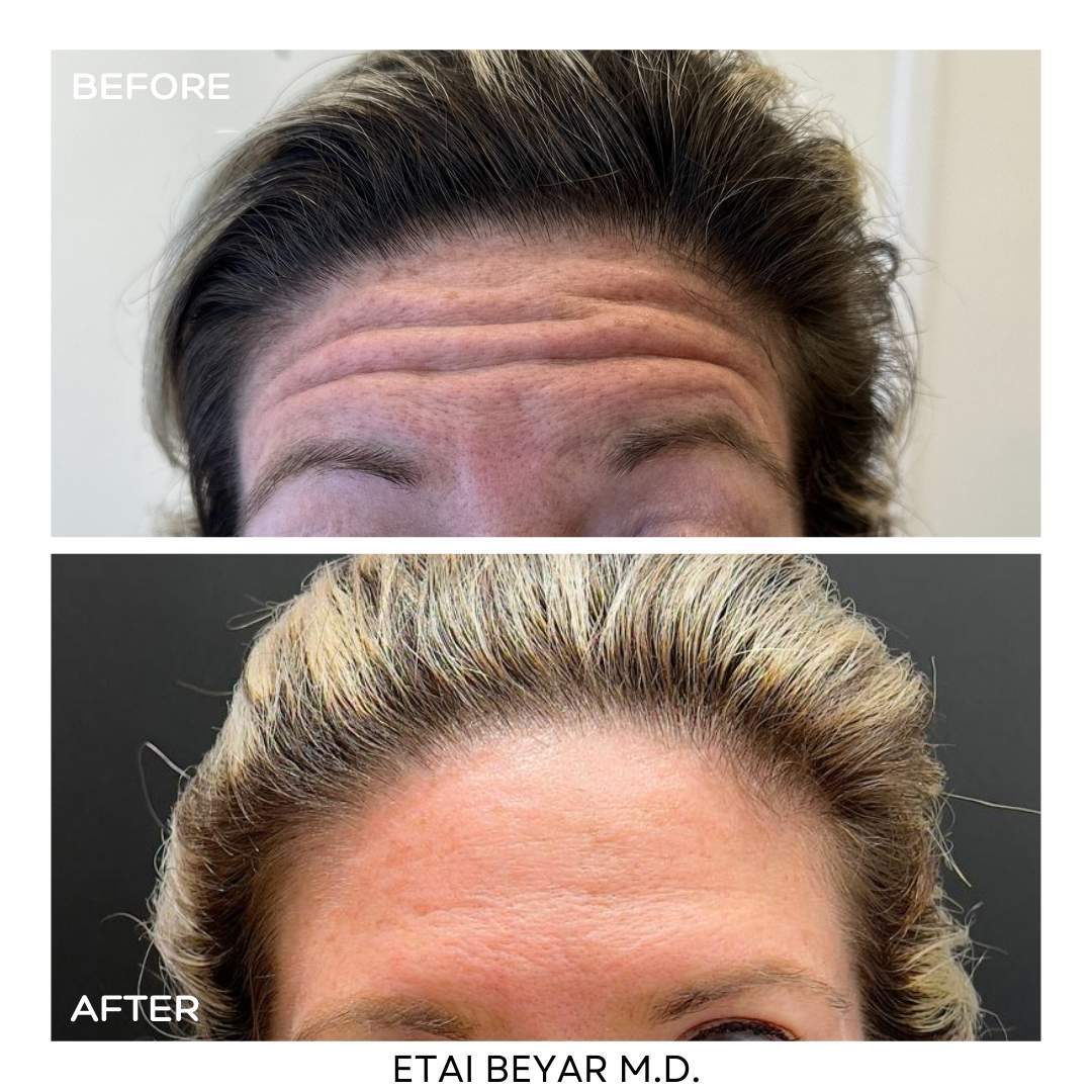 Botox Injection | Dr. Etai Beyar