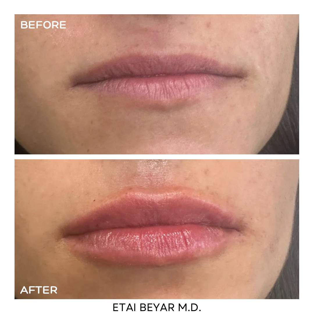 Hyaluronic Acid Injection | Dr. Etai Beyar