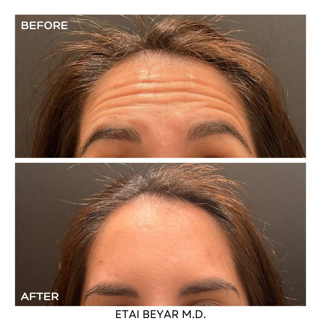 Botox Injection | Dr. Etai Beyar