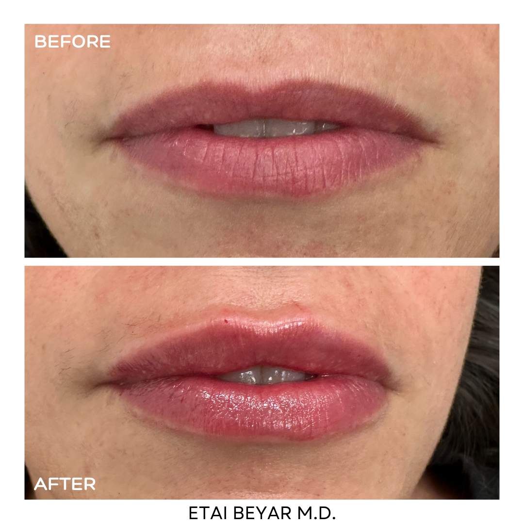 Liposculpter | Dr. Etai Beyar
