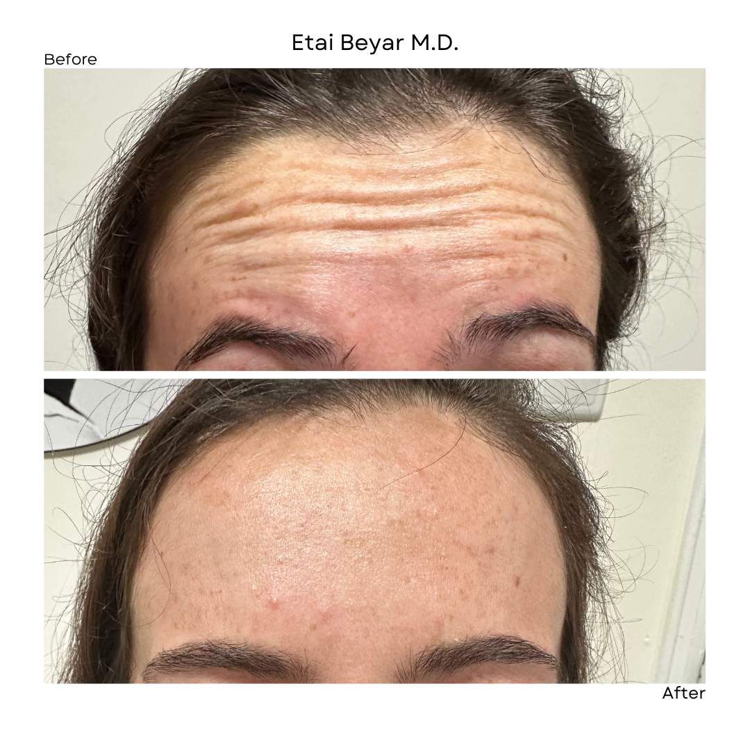 Botox Injection | Dr. Etai Beyar
