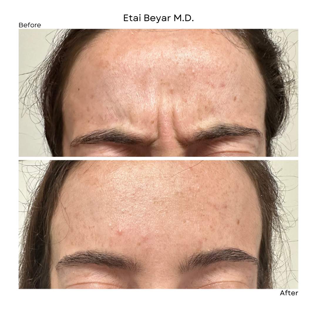Botox Injection | Dr. Etai Beyar