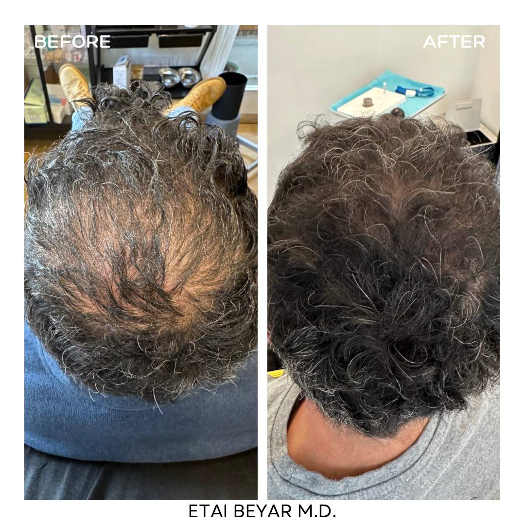 Prp For Hair | Dr. Etai Beyar