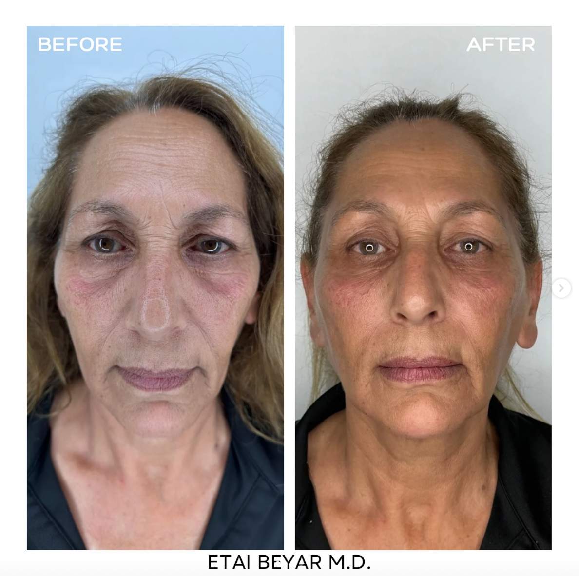 Fillers Injection | Dr. Etai Beyar