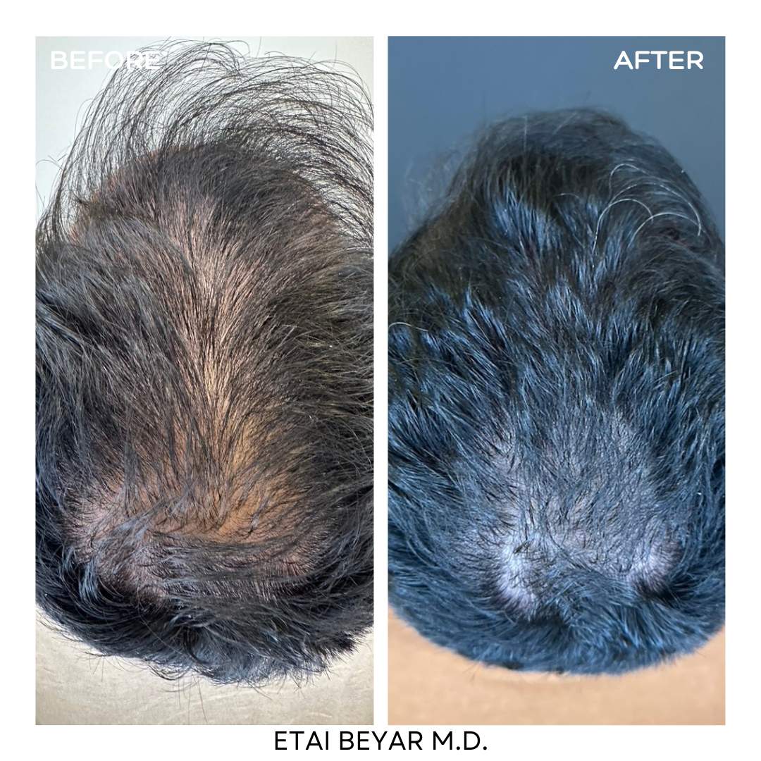 Prp For Hair | Dr. Etai Beyar