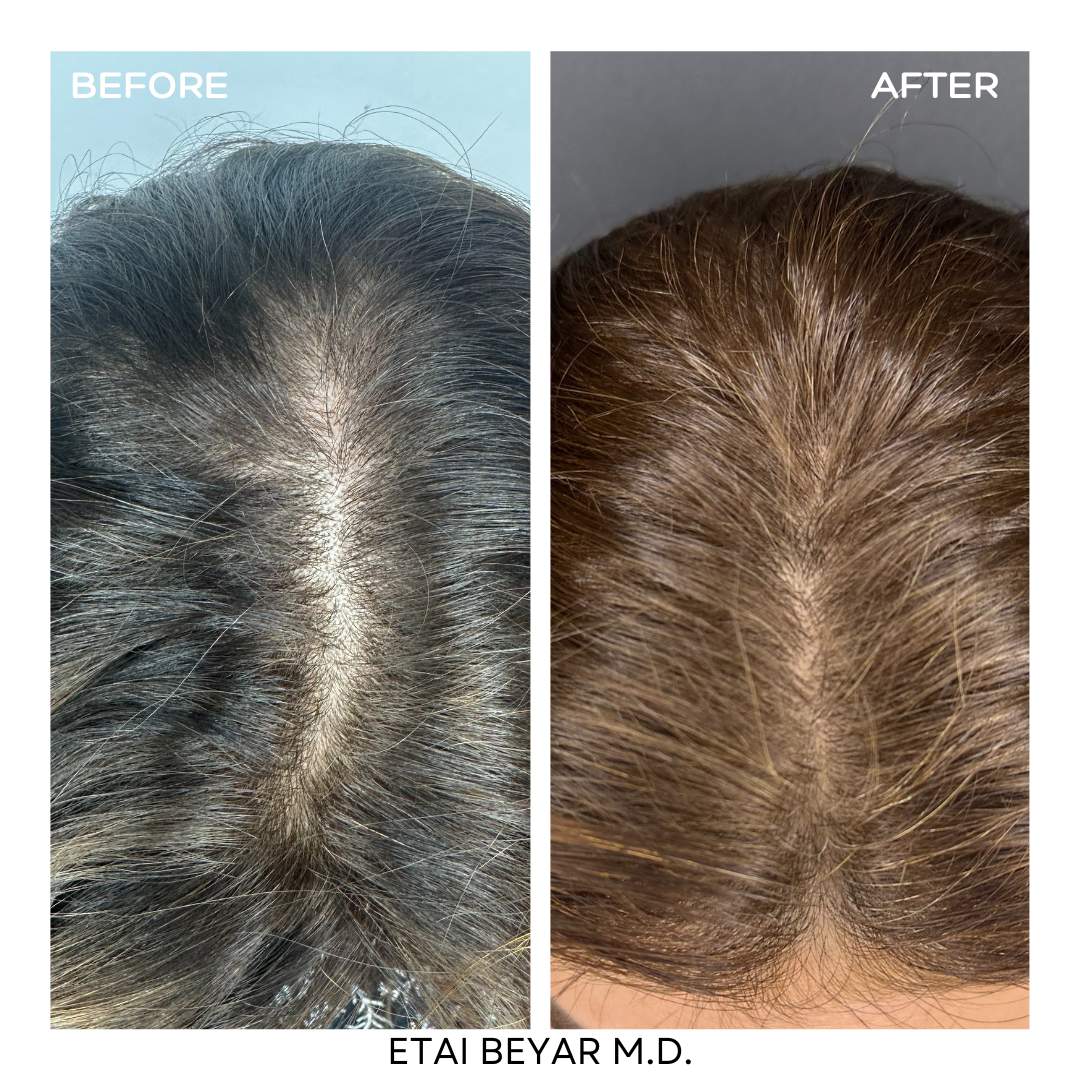 Prp For Hair | Dr. Etai Beyar