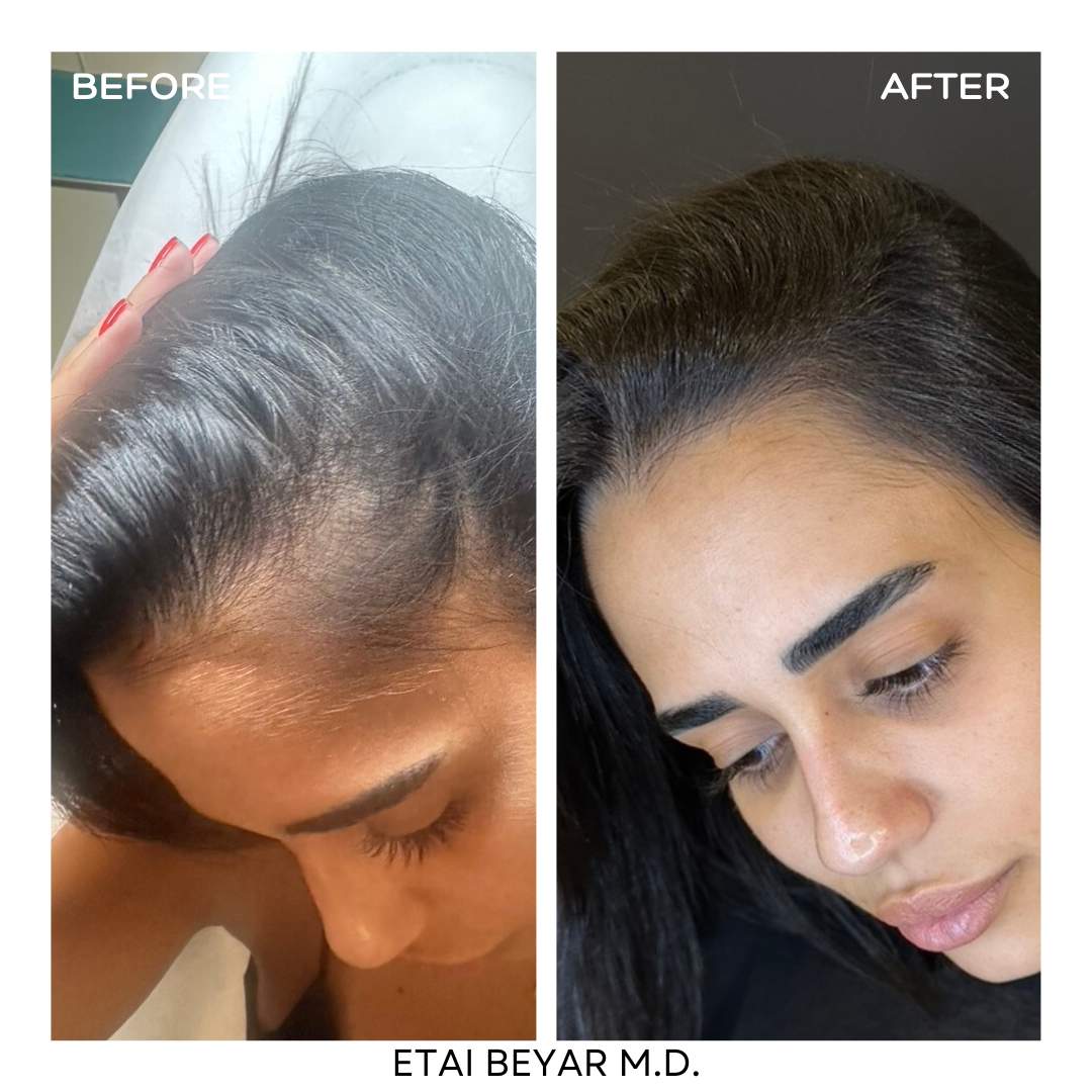 Prp+I-Prf | Dr. Etai Beyar