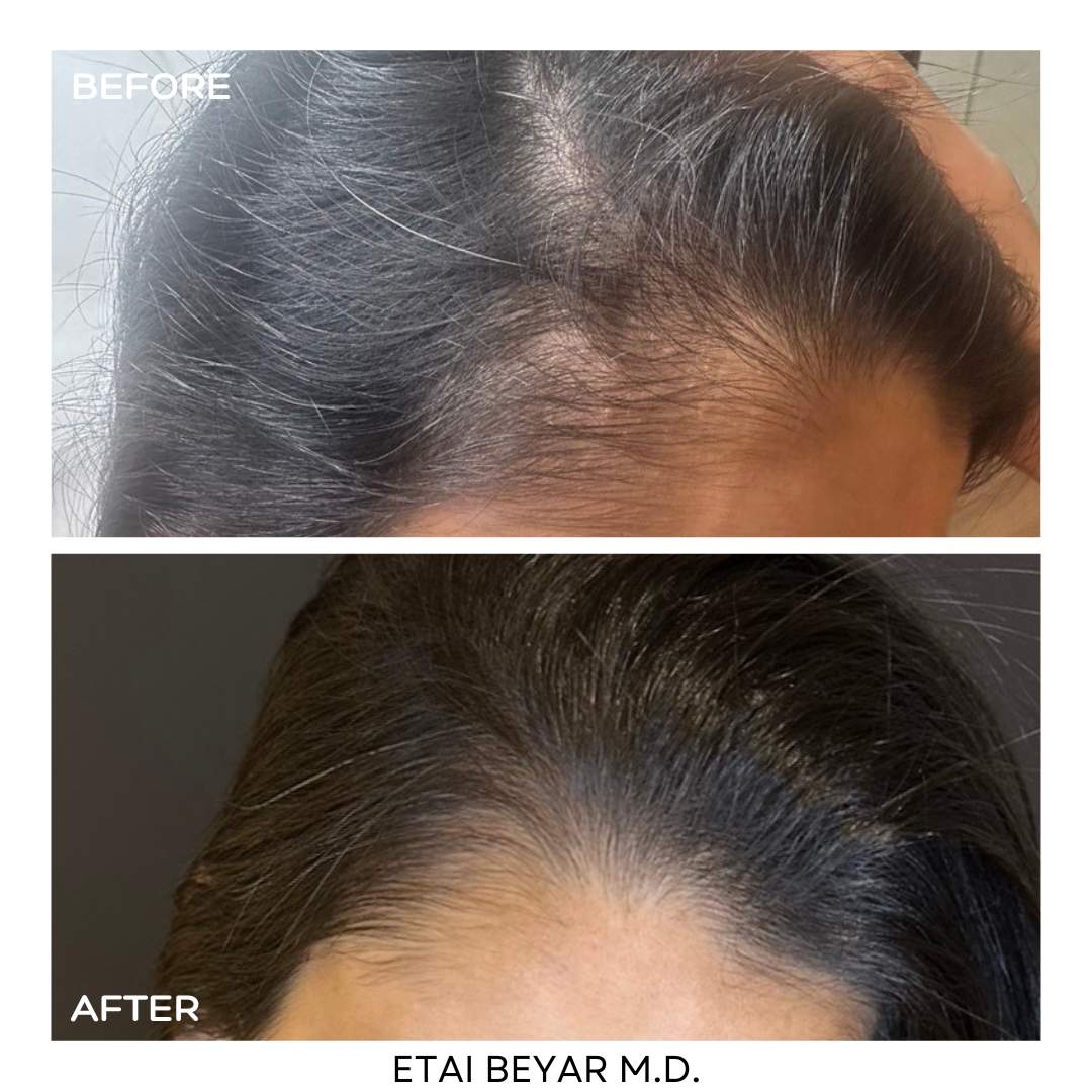 Prp For Hair | Dr. Etai Beyar