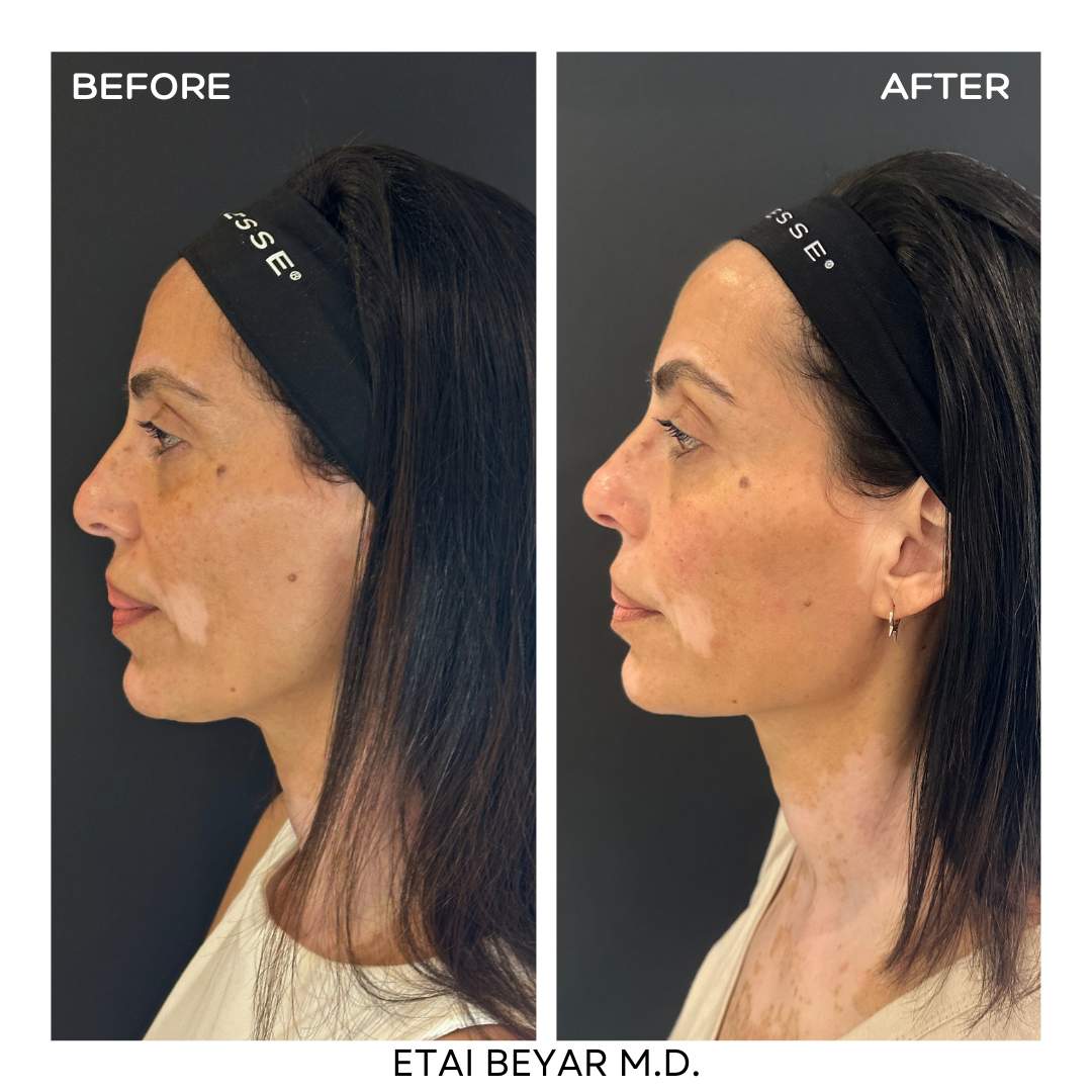Hyaluronic Acid Injection | Dr. Etai Beyar