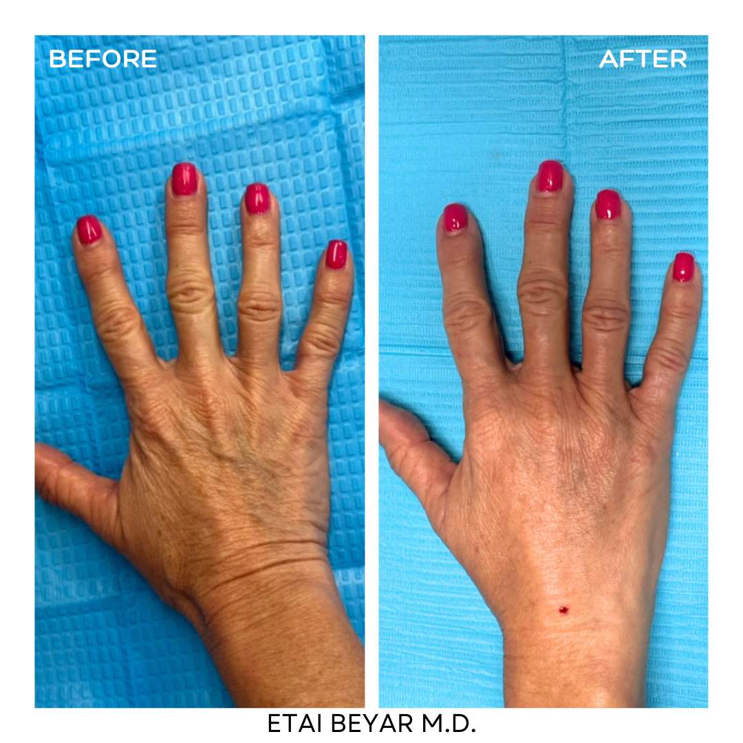 Nano fat treatment | Dr. Etai Beyar