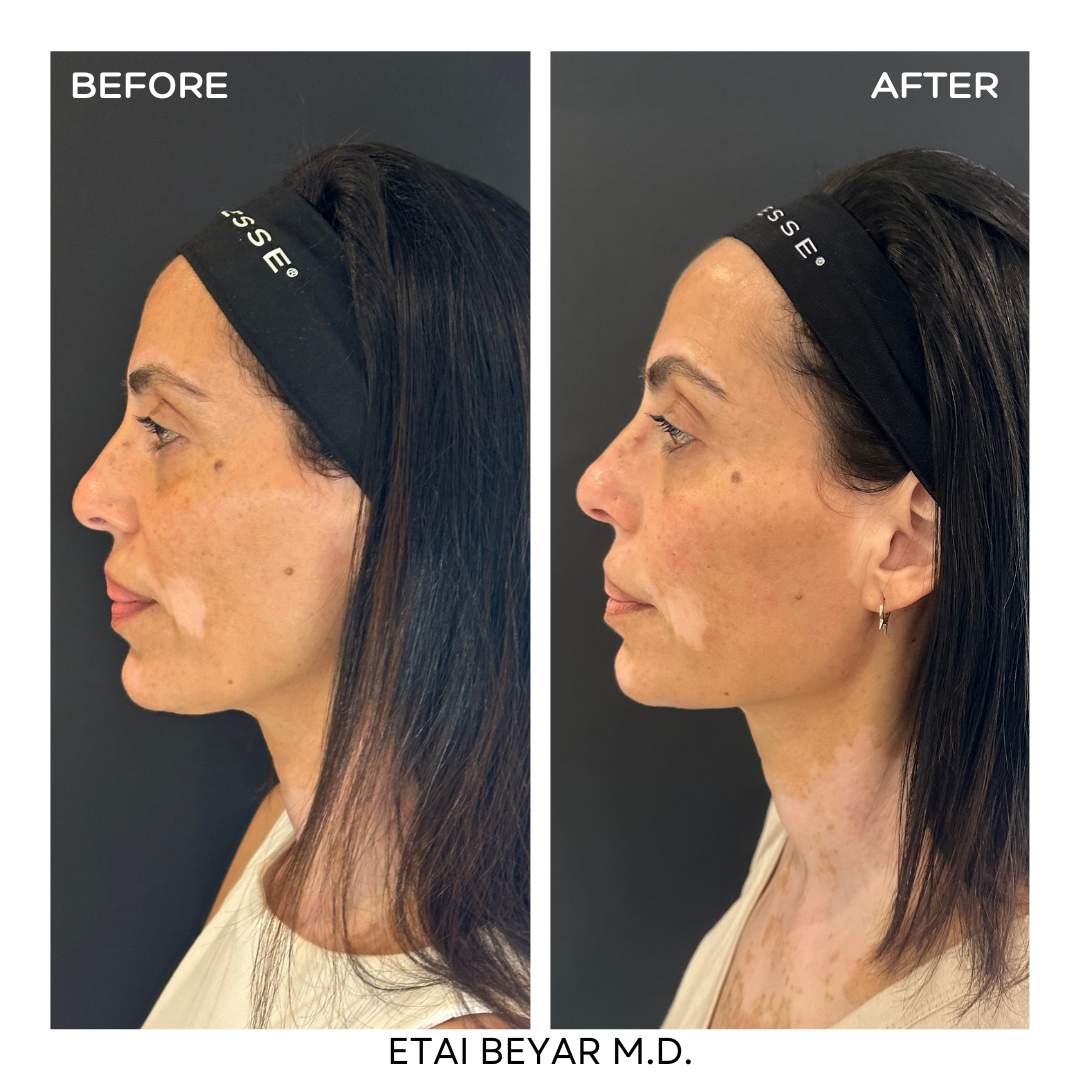 Hyaluronic Acid Injection | Dr. Etai Beyar