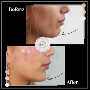 Chin augmentation - מילוי סנטר