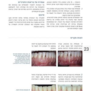 מחלות חניכיים -פריודונטיה | ד"ר מייזי אליעזר