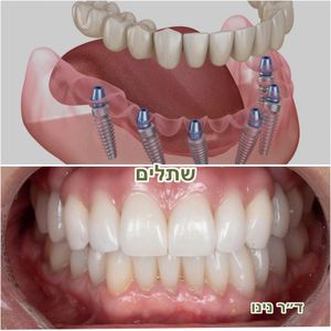 רפואת שיניים | ד"ר נינו שפוליאנסקי-נוגאידלי