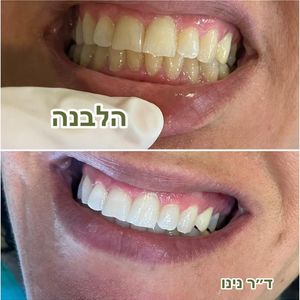 רפואת שיניים | ד"ר נינו שפוליאנסקי-נוגאידלי
