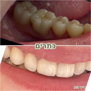 רפואת שיניים | ד"ר נינו שפוליאנסקי-נוגאידלי