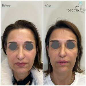 אסתטיקת פנים | ד"ר תם אלקסלסי