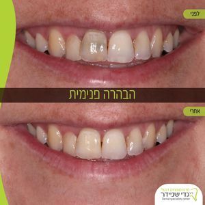 השתלות שיניים | ד"ר גדי שניידר