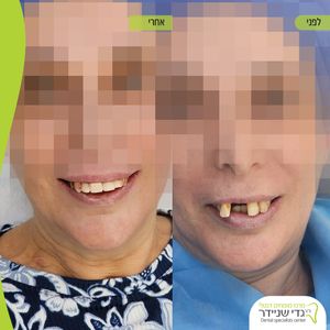 השתלות שיניים | ד"ר גדי שניידר