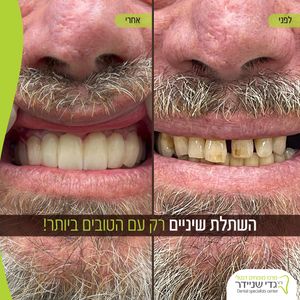 השתלות שיניים | ד"ר גדי שניידר