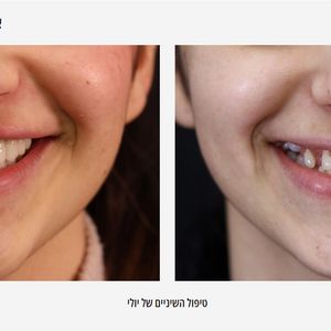 השתלות שיניים | ד"ר גדי שניידר