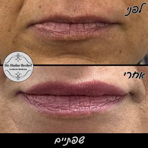 אסתטיקת פנים | ד"ר הדר רשף