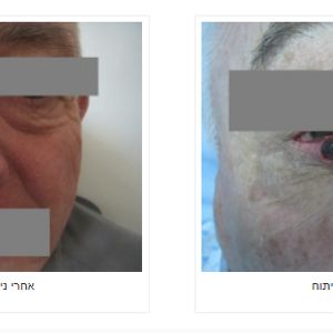 כירורגיה פלסטית | ד"ר אהוד מילר