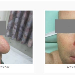 כירורגיה פלסטית | ד"ר אהוד מילר