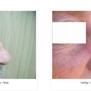 כירורגיה פלסטית | ד"ר אהוד מילר