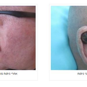 כירורגיה פלסטית | ד"ר אהוד מילר