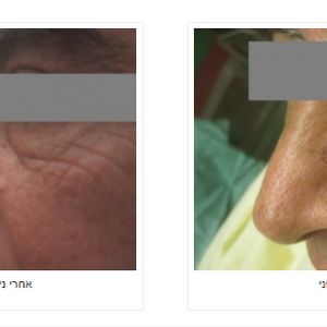 כירורגיה פלסטית | ד"ר אהוד מילר