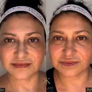 אסתטיקת פנים | כץ קליניק katz clinic