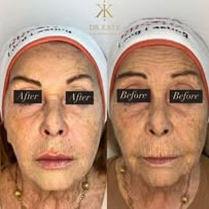 אסתטיקת פנים | כץ קליניק katz clinic